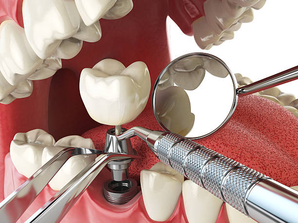 Best Emergency Broken Tooth Repair in Stepney, CT